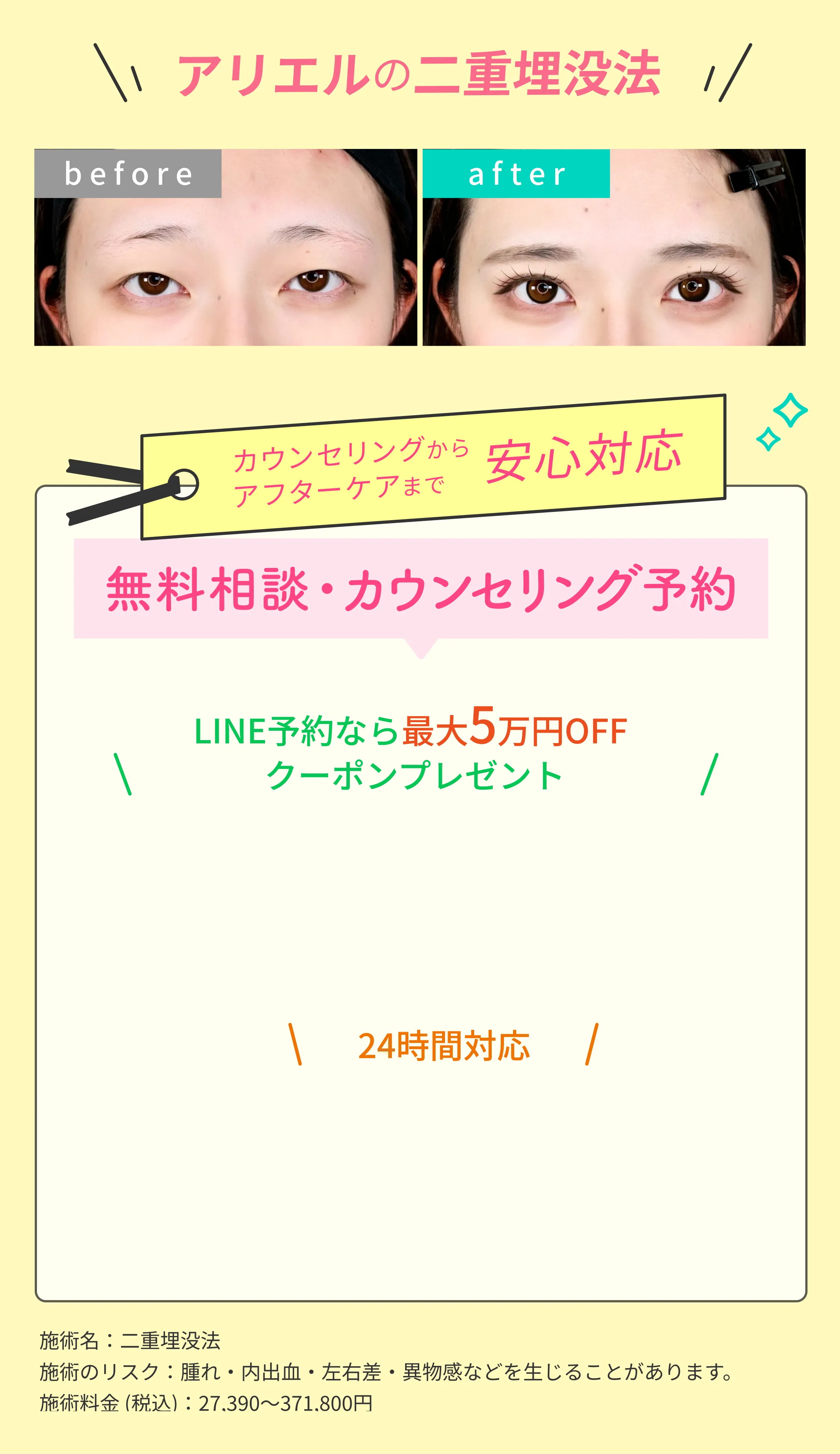 アリエルの二重埋没法ビフォーアフター写真 カウンセリングからアフターケアまで安心対応 無料相談・カウンセリング予約 LINE予約なら最大5万円OFFクーポンプレゼント 24時間対応