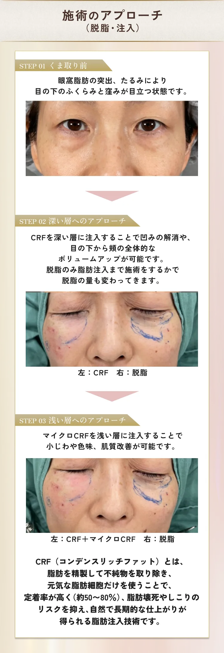 目の下のクマ・たるみ取り アリエル美容クリニック