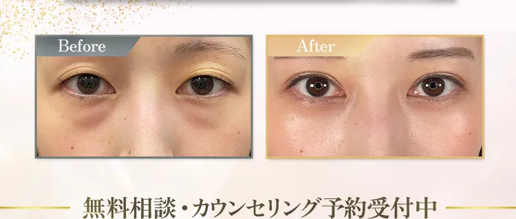 目の下のクマ・たるみ取り アリエル美容クリニック