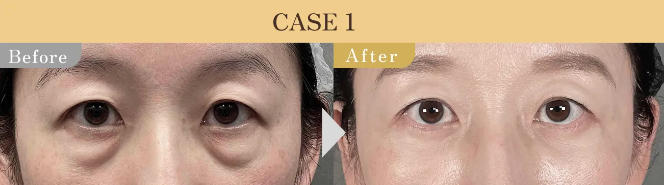 目の下のクマ・たるみ取り アリエル美容クリニック