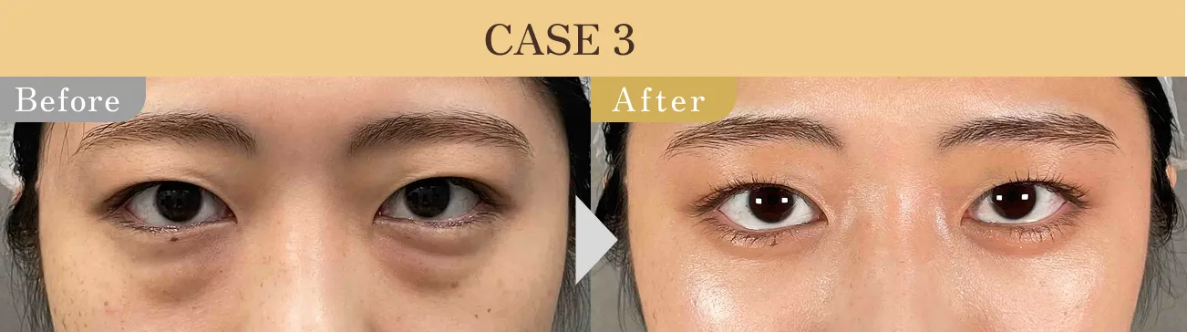 目の下のクマ・たるみ取り アリエル美容クリニック