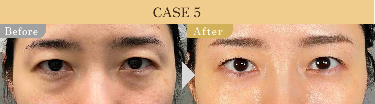 目の下のクマ・たるみ取り アリエル美容クリニック