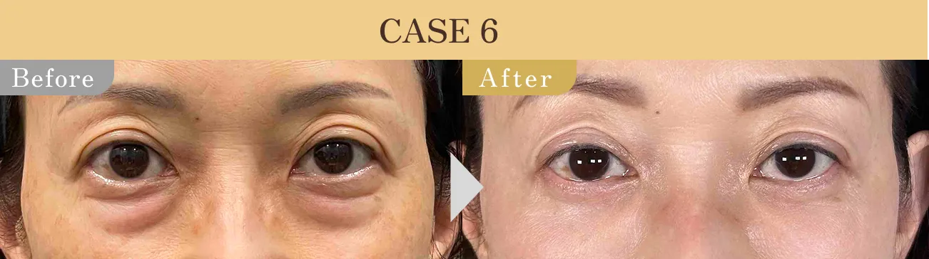 目の下のクマ・たるみ取り アリエル美容クリニック