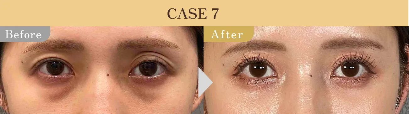 目の下のクマ・たるみ取り アリエル美容クリニック