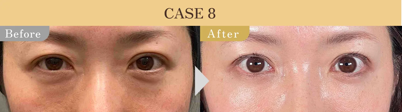 目の下のクマ・たるみ取り アリエル美容クリニック