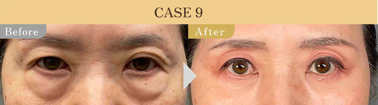 目の下のクマ・たるみ取り アリエル美容クリニック