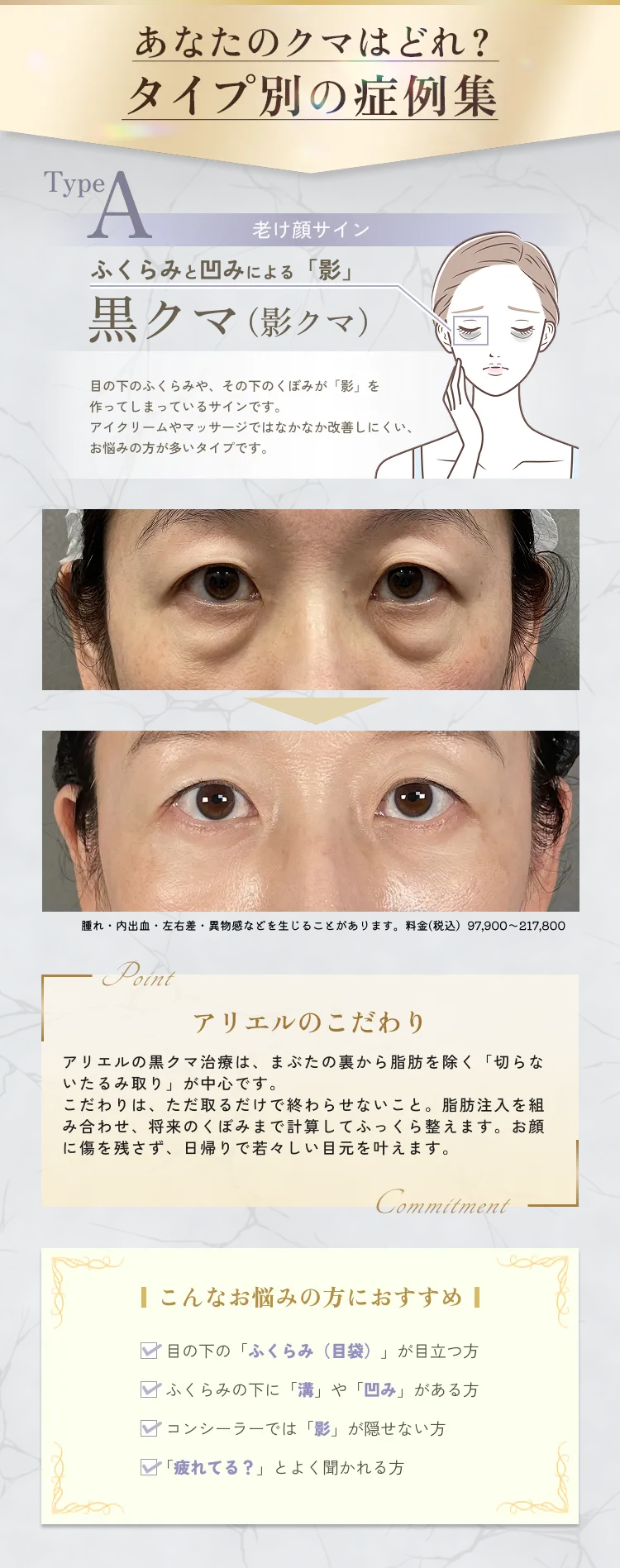 目の下のクマ・たるみ取り アリエル美容クリニック