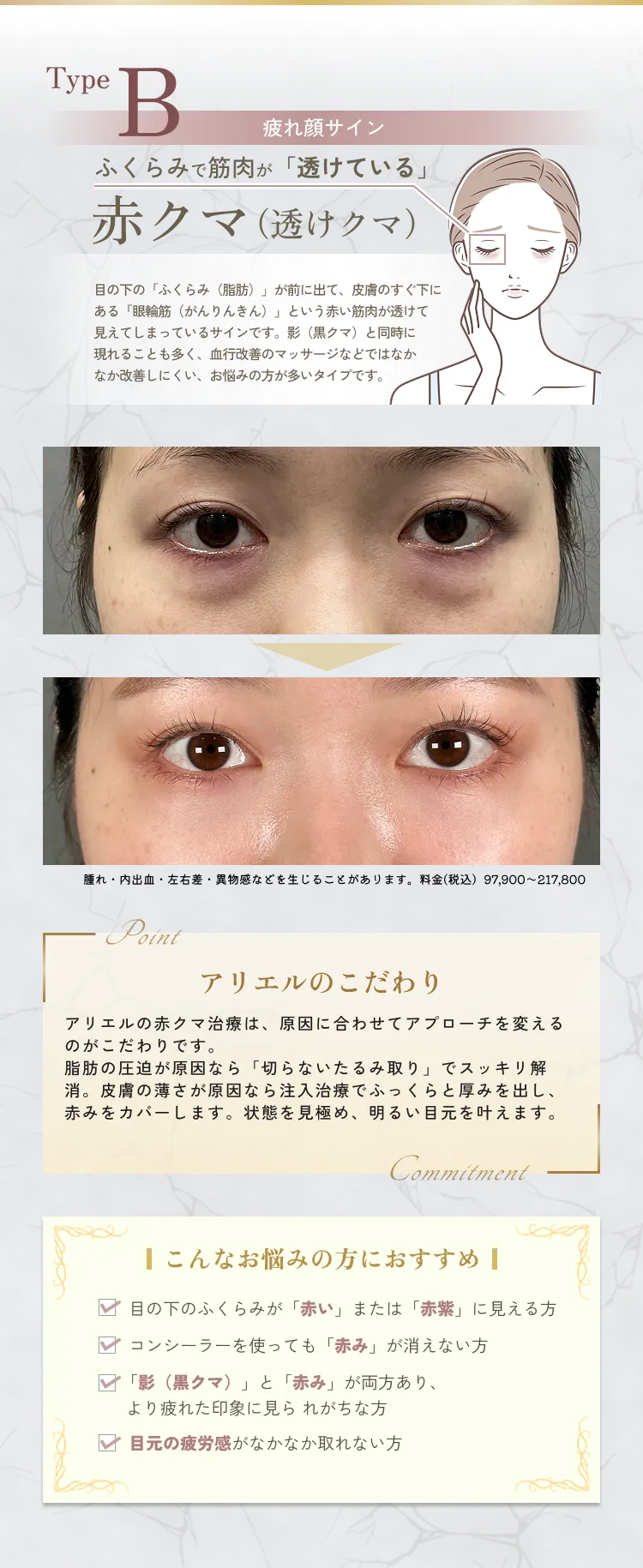 目の下のクマ・たるみ取り アリエル美容クリニック