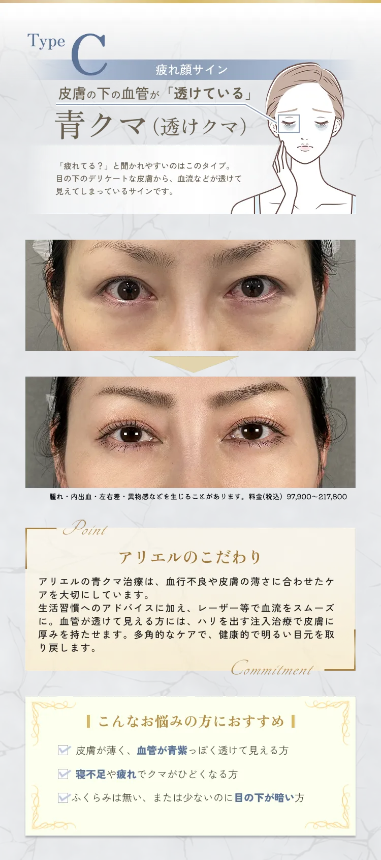 目の下のクマ・たるみ取り アリエル美容クリニック