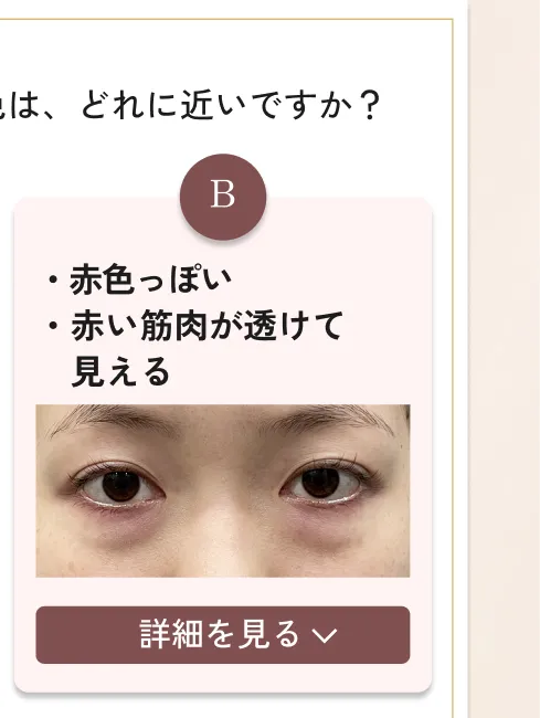 目の下のクマ・たるみ取り アリエル美容クリニック