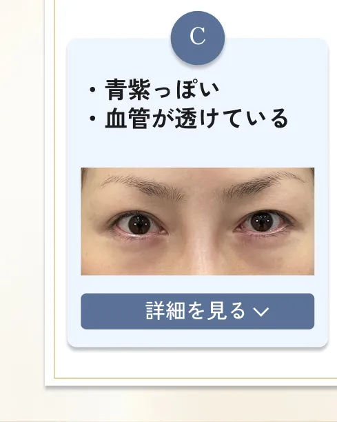 目の下のクマ・たるみ取り アリエル美容クリニック