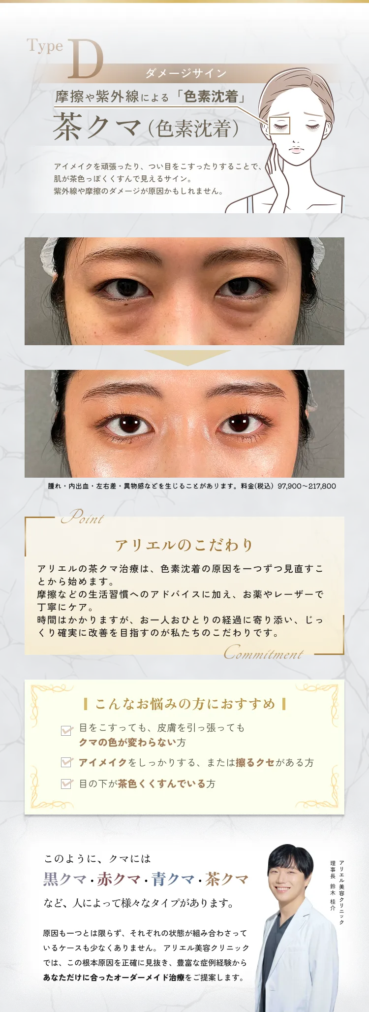 目の下のクマ・たるみ取り アリエル美容クリニック