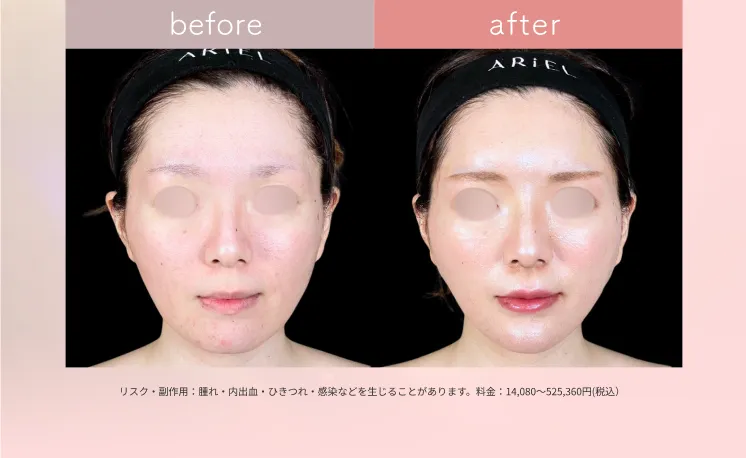 糸リフト アリエル美容クリニック