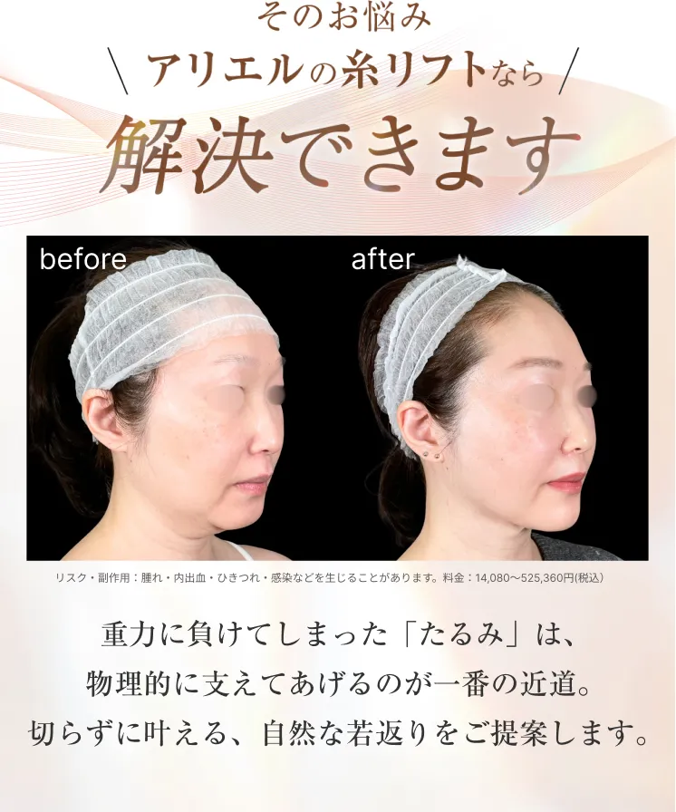 糸リフト アリエル美容クリニック