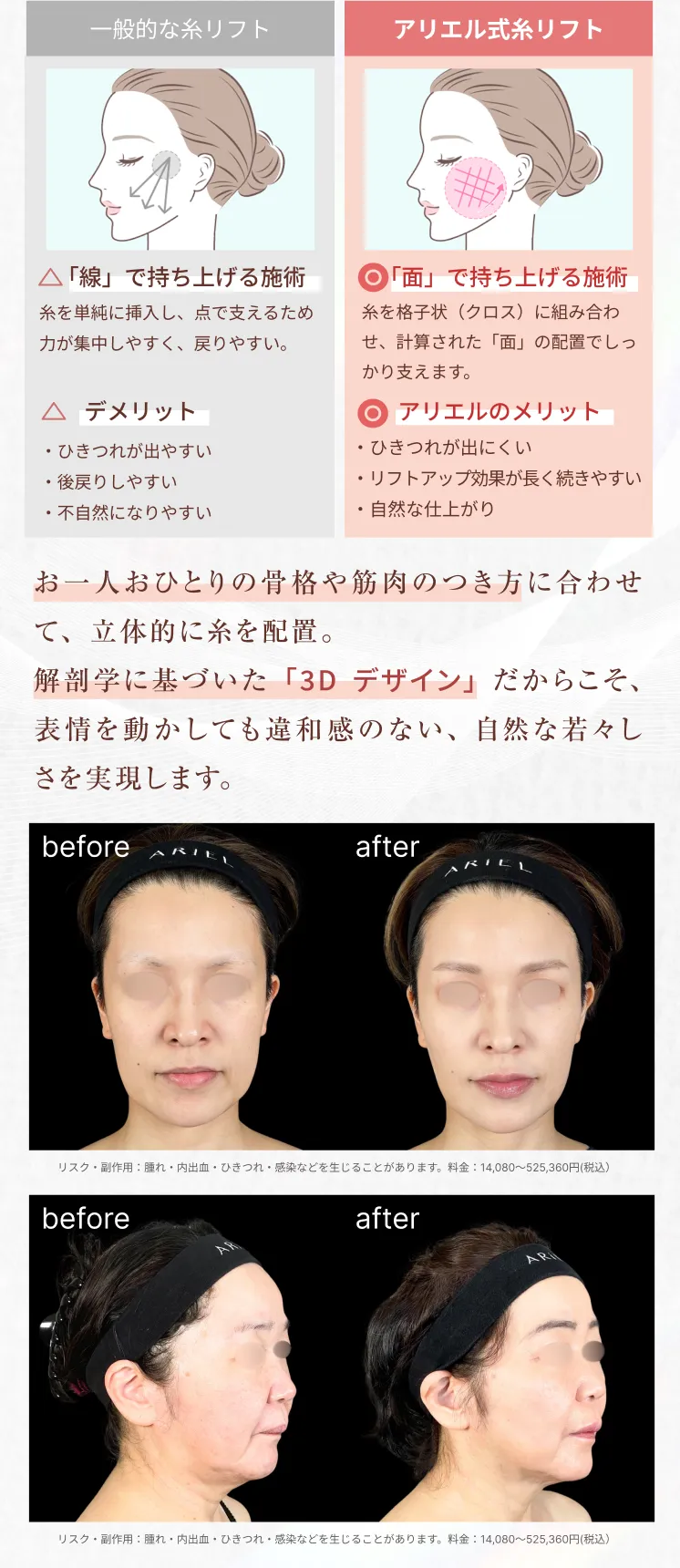 糸リフト アリエル美容クリニック