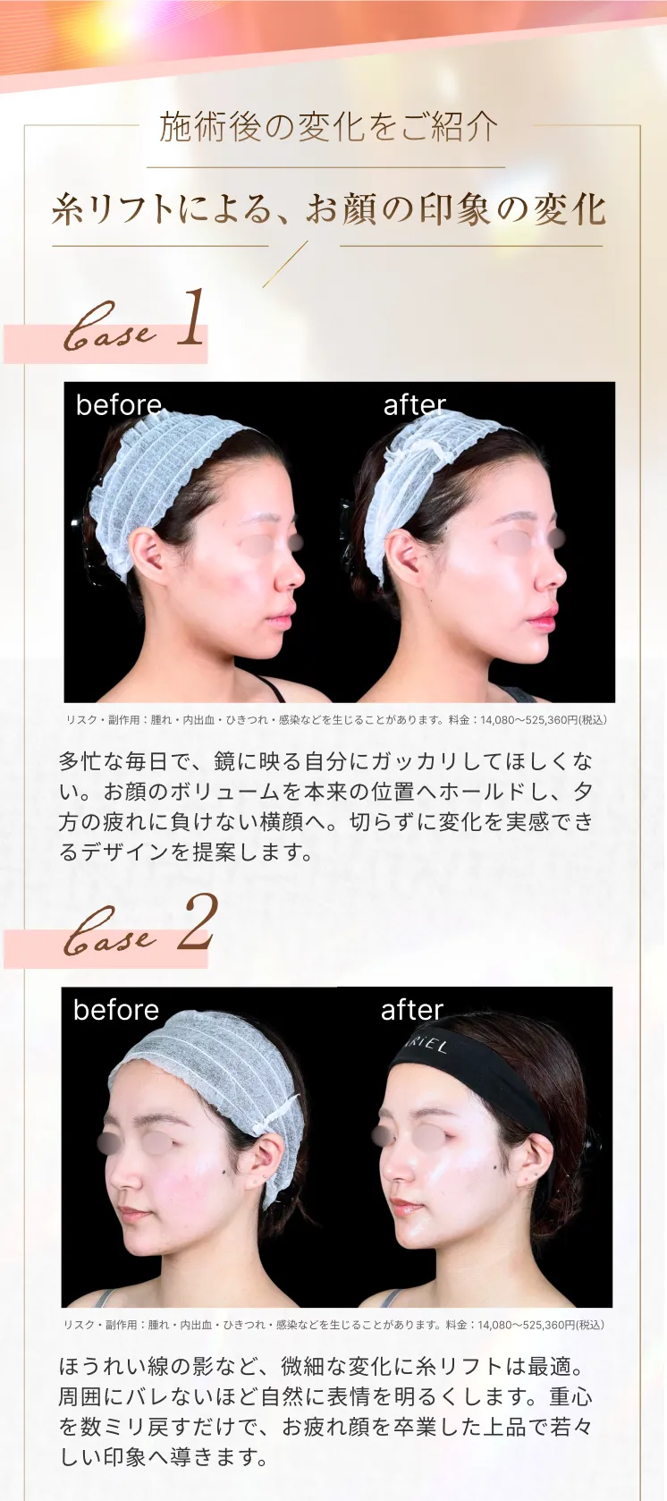 糸リフト アリエル美容クリニック