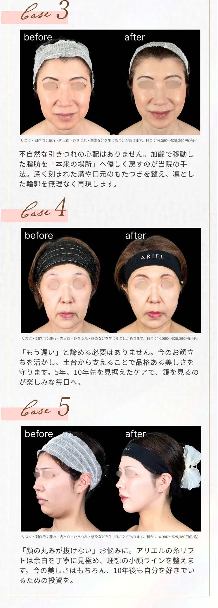 糸リフト アリエル美容クリニック