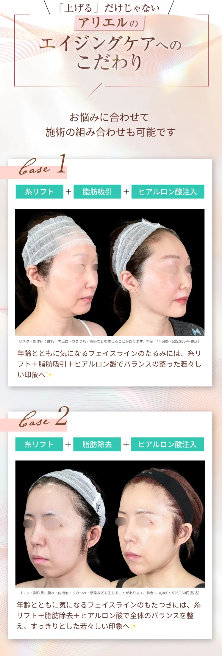 糸リフト アリエル美容クリニック