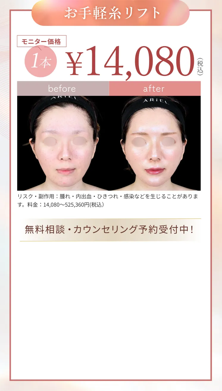 糸リフト アリエル美容クリニック