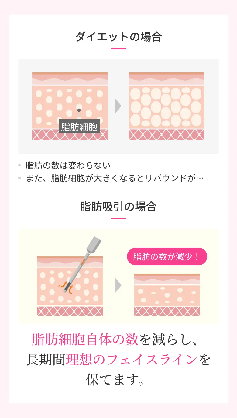脂肪吸引の場合 脂肪細胞自体の数を減らし、長期間理想のフェイスラインを保てます。