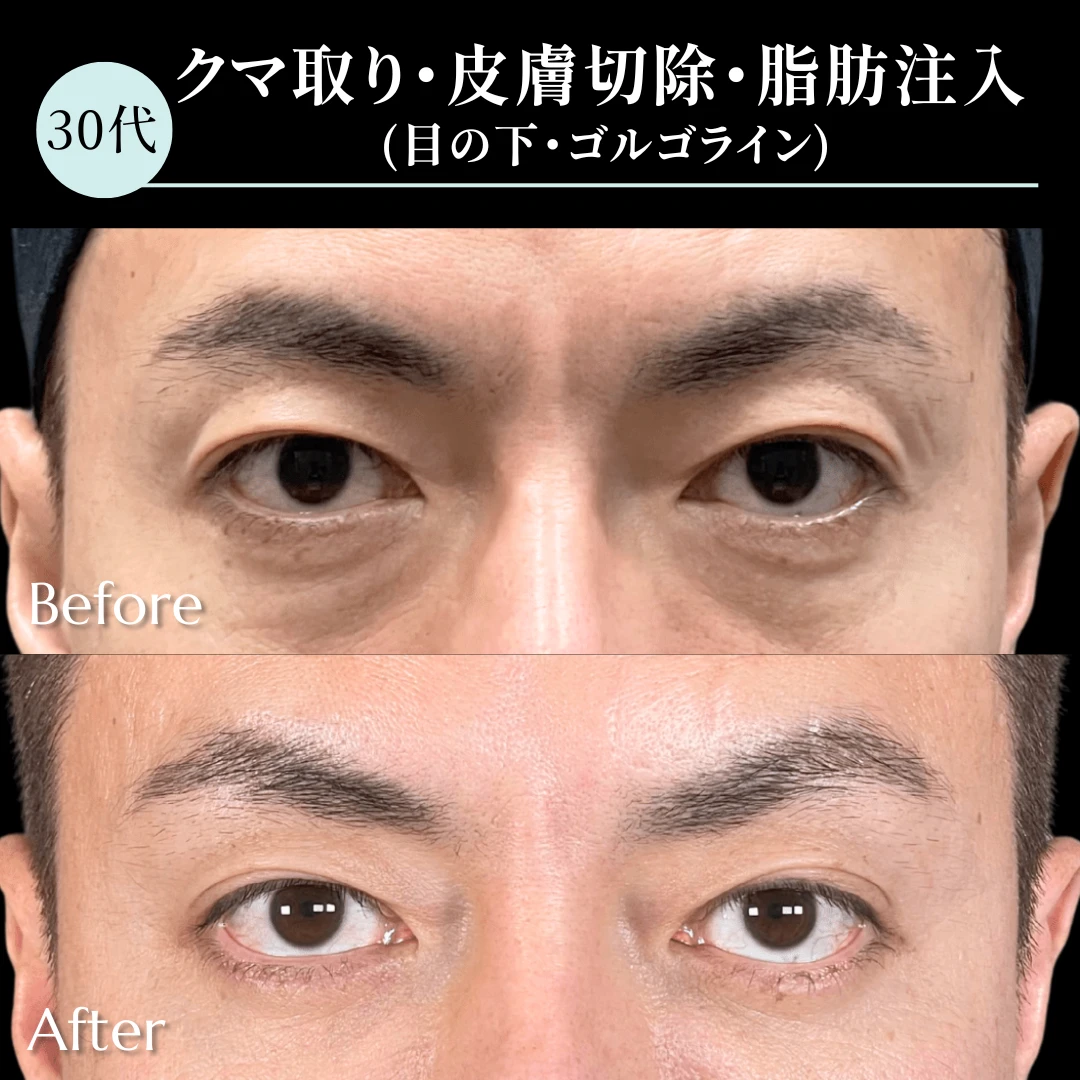 クマ取り/皮膚切除/脂肪注入（目の下・ゴルゴライン）