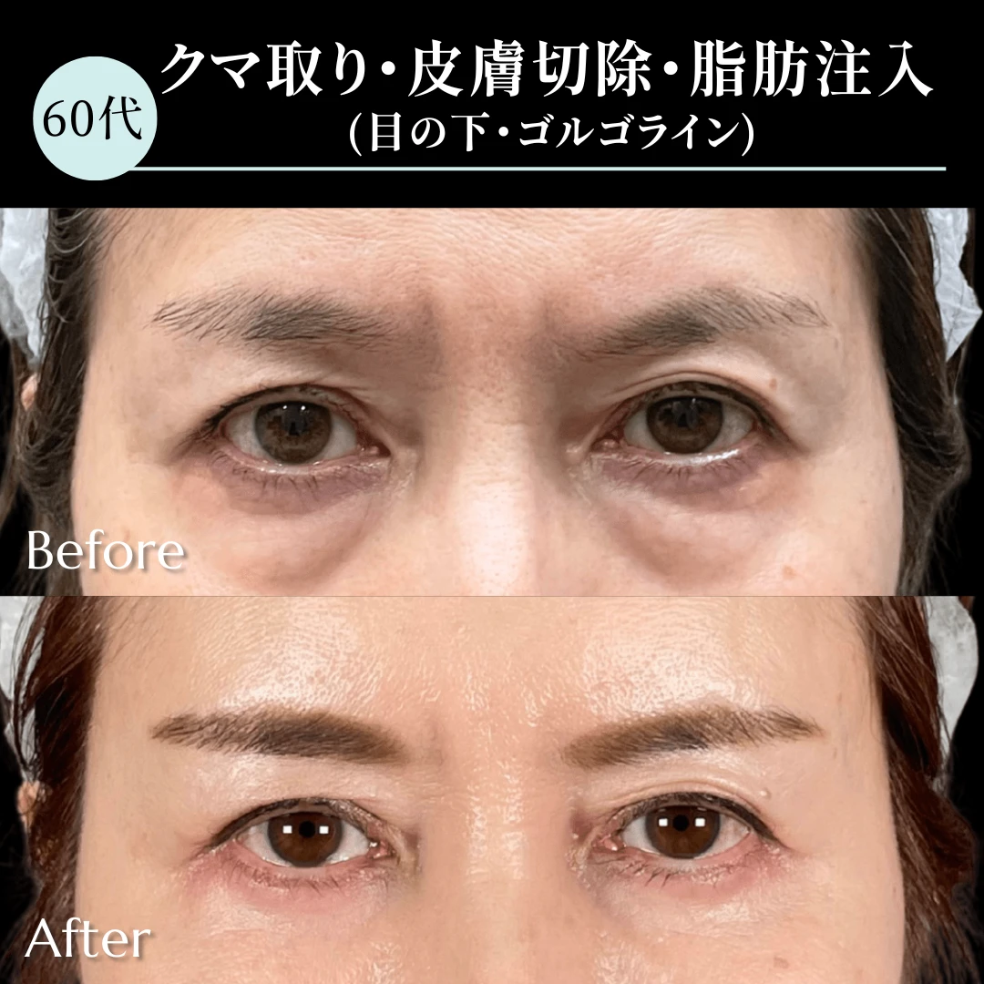 クマ取り/皮膚切除/脂肪注入（目の下・ゴルゴライン）