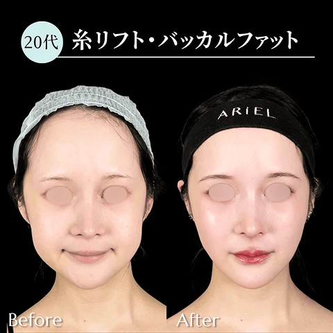 糸リフト/バッカルファット/ジョールファット/エラボトックス/唇ヒアルロン酸