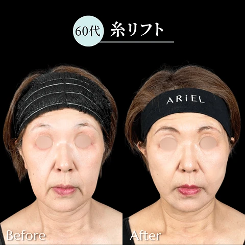 糸リフト