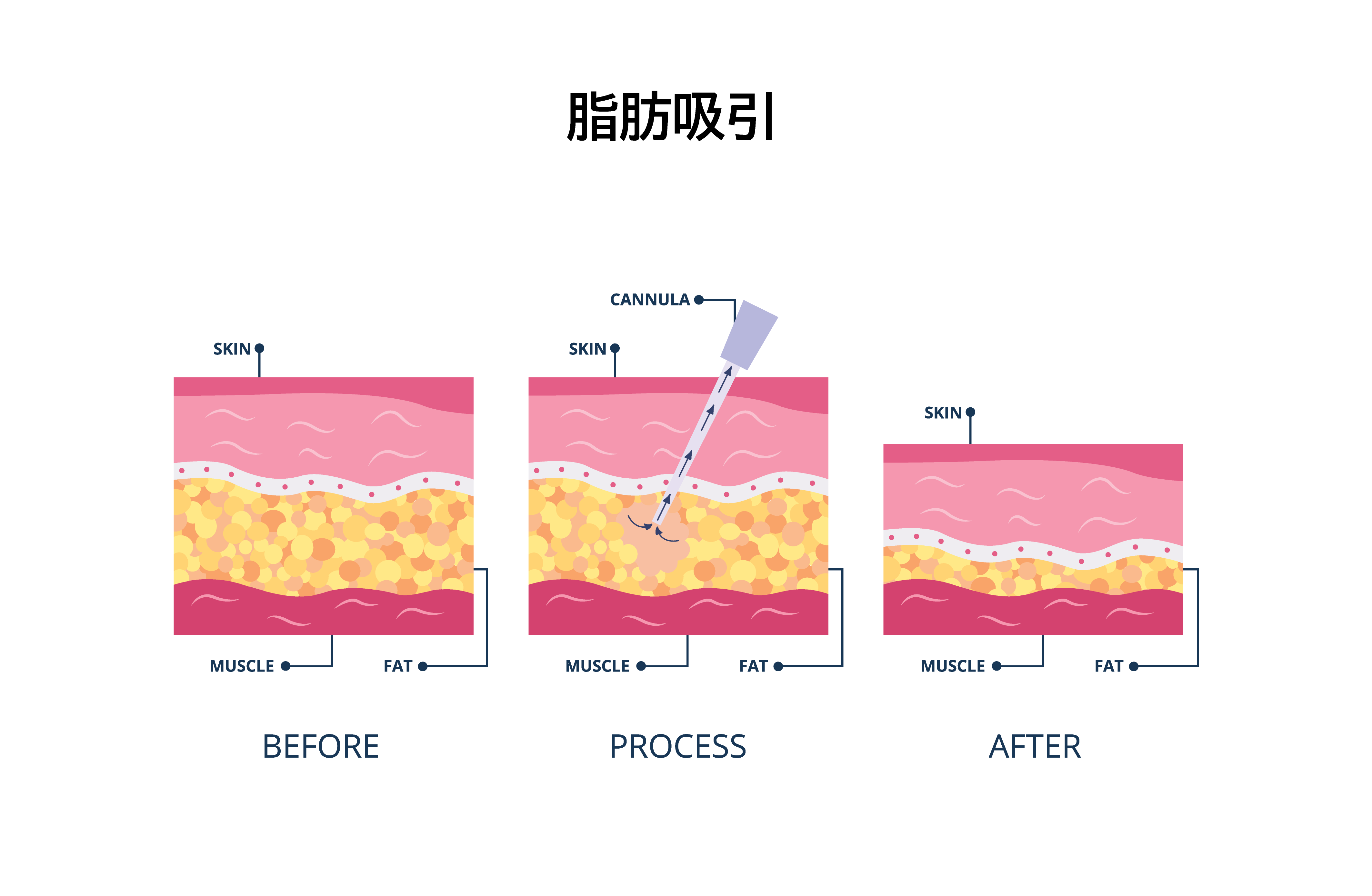 顔の脂肪吸引とは