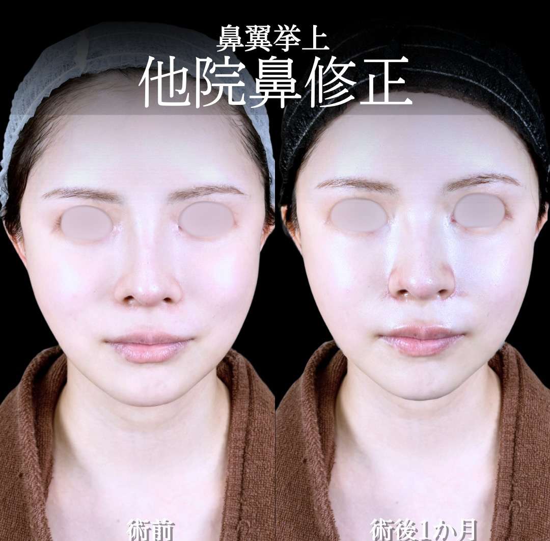 鼻翼 