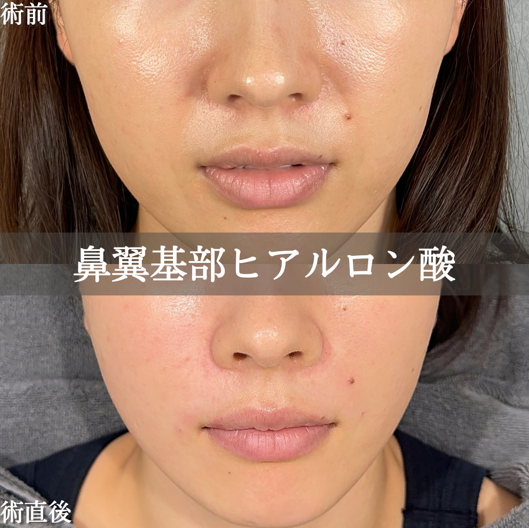 鼻翼 30代女性の症例写真】鼻翼基部ヒアルロン酸注入 No.11933｜埼玉県さいたま市大宮区の美容外科・美容皮膚科アリエル美容クリニック