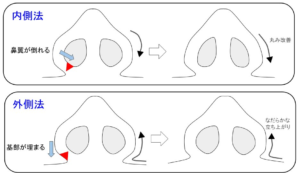 鼻翼縮小