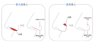 鼻孔縁挙上・鼻翼挙上