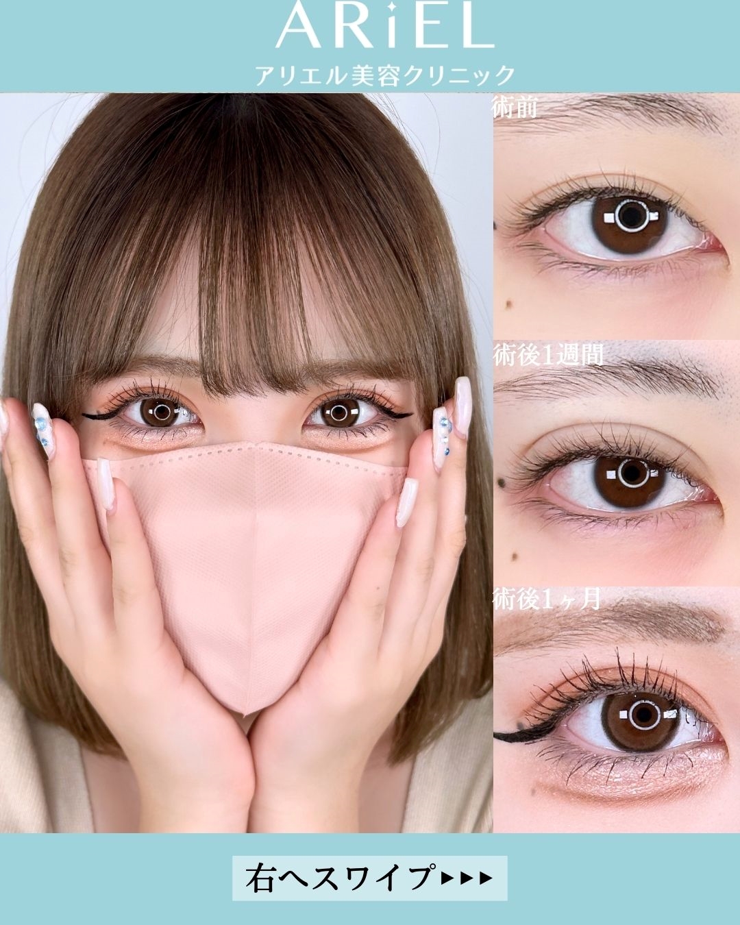 【20代女性の症例写真】アリエルクイックループダブル二重埋没法 No.14261｜埼玉県さいたま市大宮区の美容外科・美容皮膚科アリエル美容クリニック