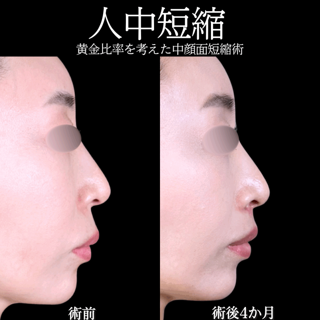 人中短縮 No.16528